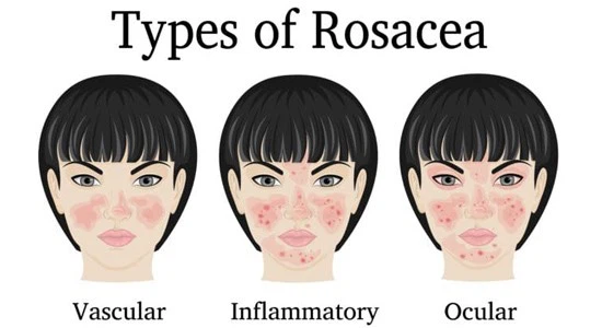 Ivermectin Stromectol Tablet | Shaanxi BLOOM Tech Co., Ltd Ivermectin Stromectol Tablet | Shaanxi BLOOM Tech Co., Ltd